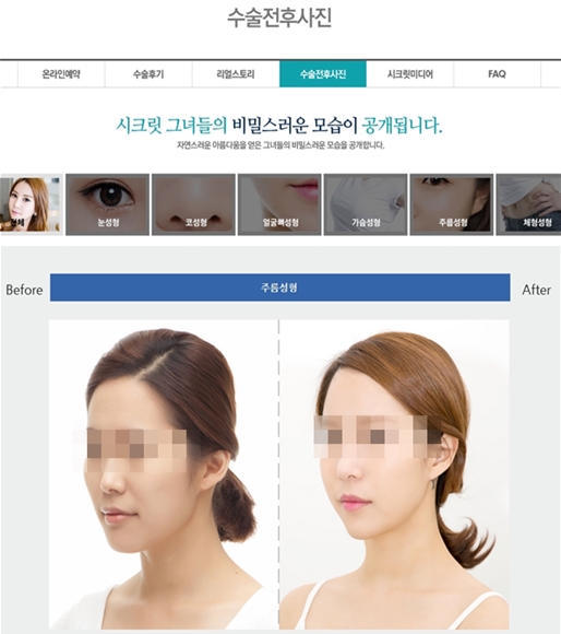 시크릿 성형외과의 홈페이지 광고 - 성형 후 사진 과장 (공정위 제공)